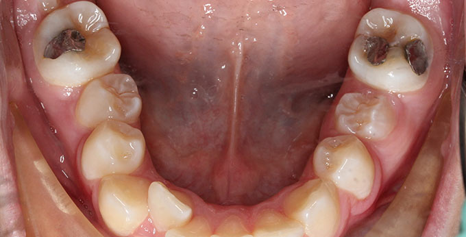 Female lower teeth before treatment for severe dental crowding and misalignment braces required